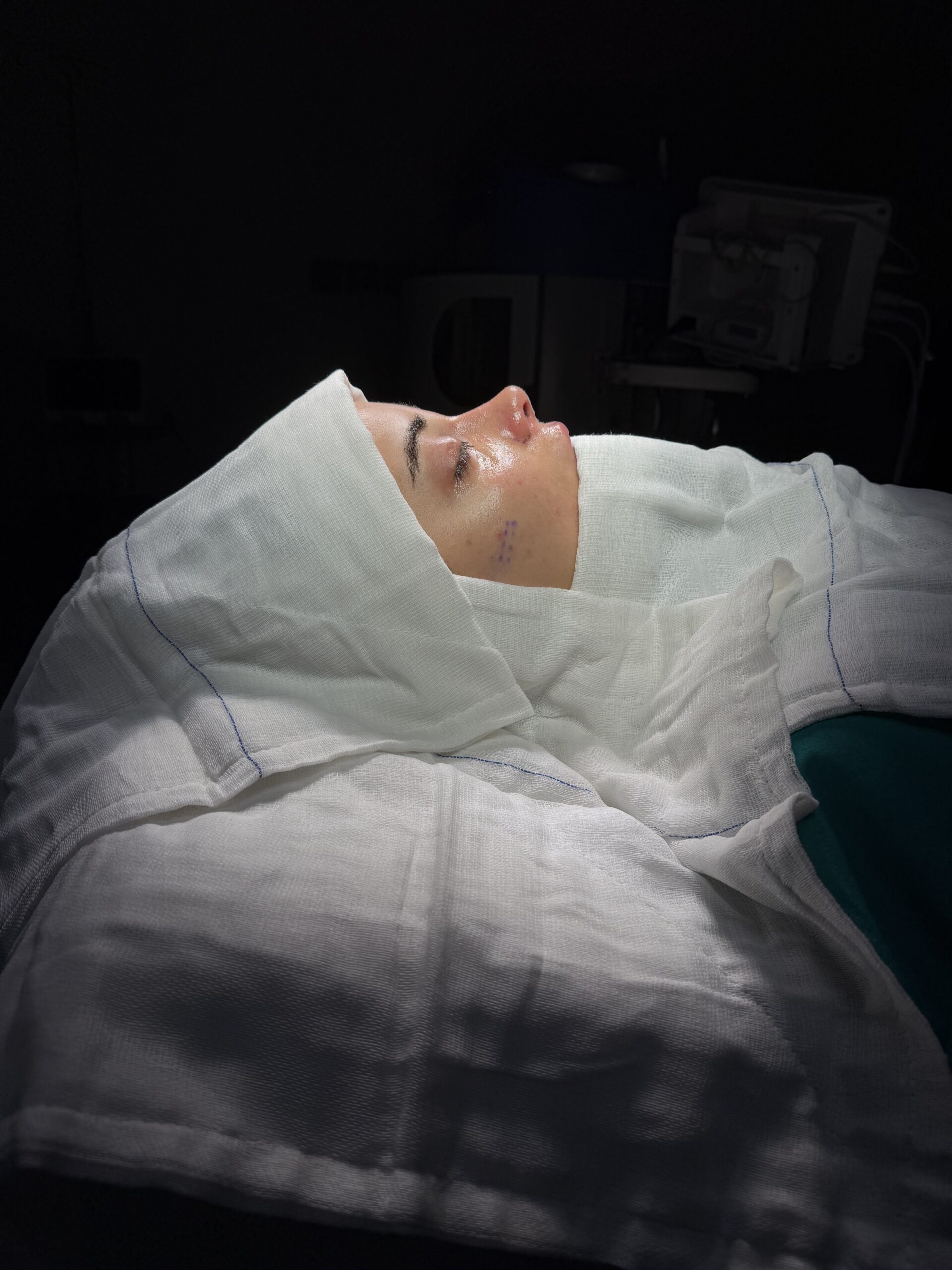 Chirurgo per blefaroplastica a Caserta