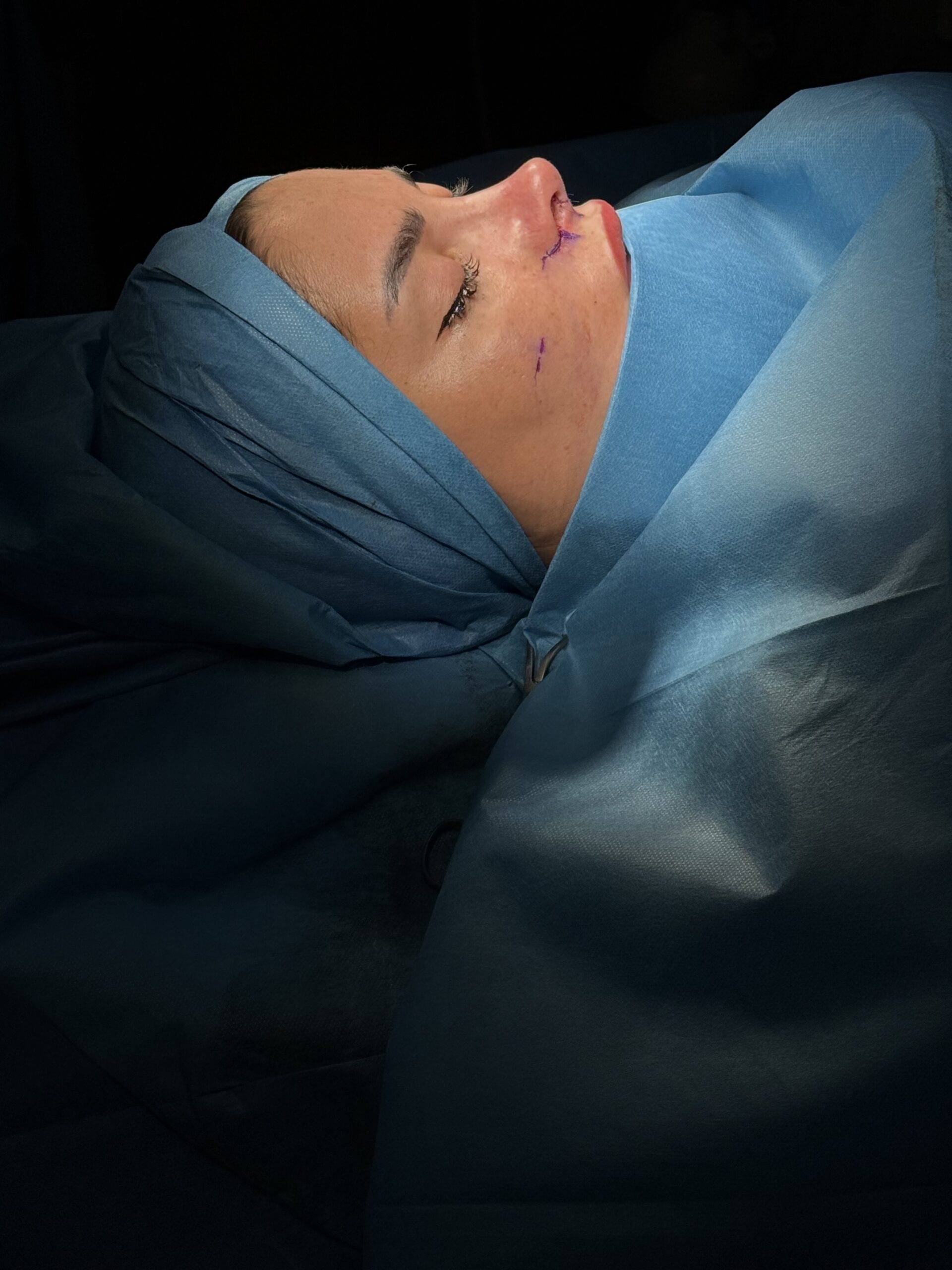 Chirurgo per blefaroplastica a Caserta